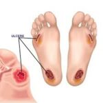 piede diabetico , arto ischemico